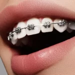 Braces and Nutrition: How Diet Impacts Orthodontic Success