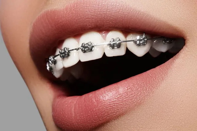 Braces and Nutrition: How Diet Impacts Orthodontic Success